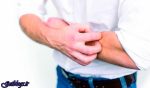 اگزمای شدید خطر حمله قلبی و سکته مغزی را زیاد کردن می دهد